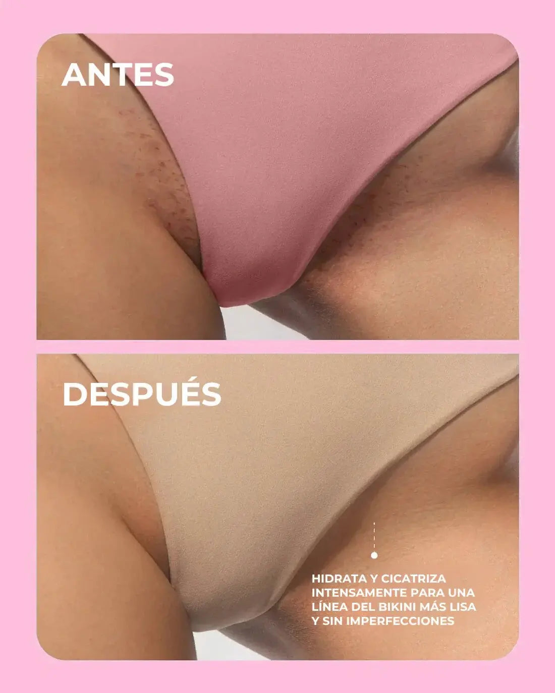 ¿Piel irritada y con granitos tras depilarte? Despídete del dolor con el Ritual Soft Serve: OFERTA ESPECIAL 2x1